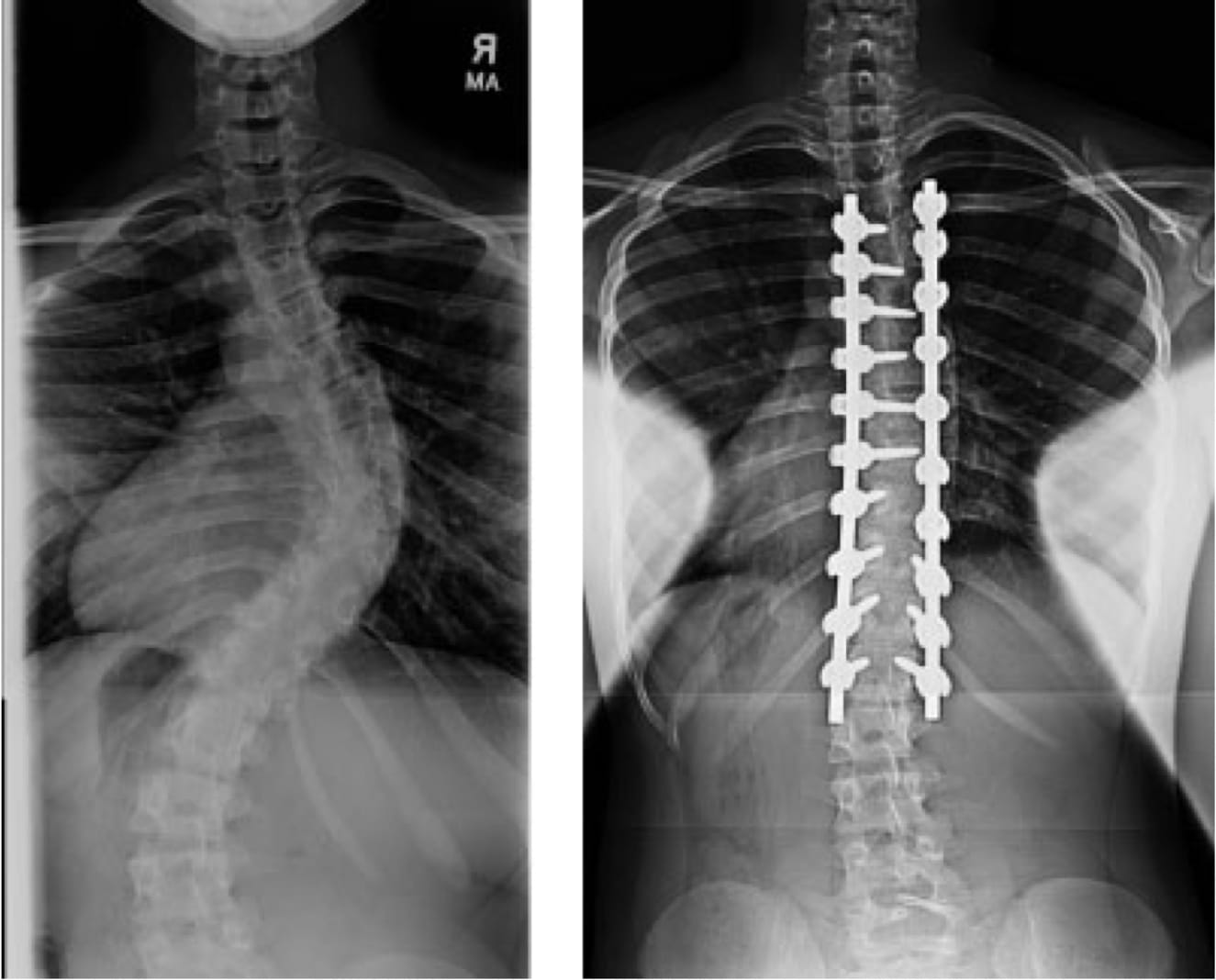 Adolescent Idiopathic Scoliosis case study