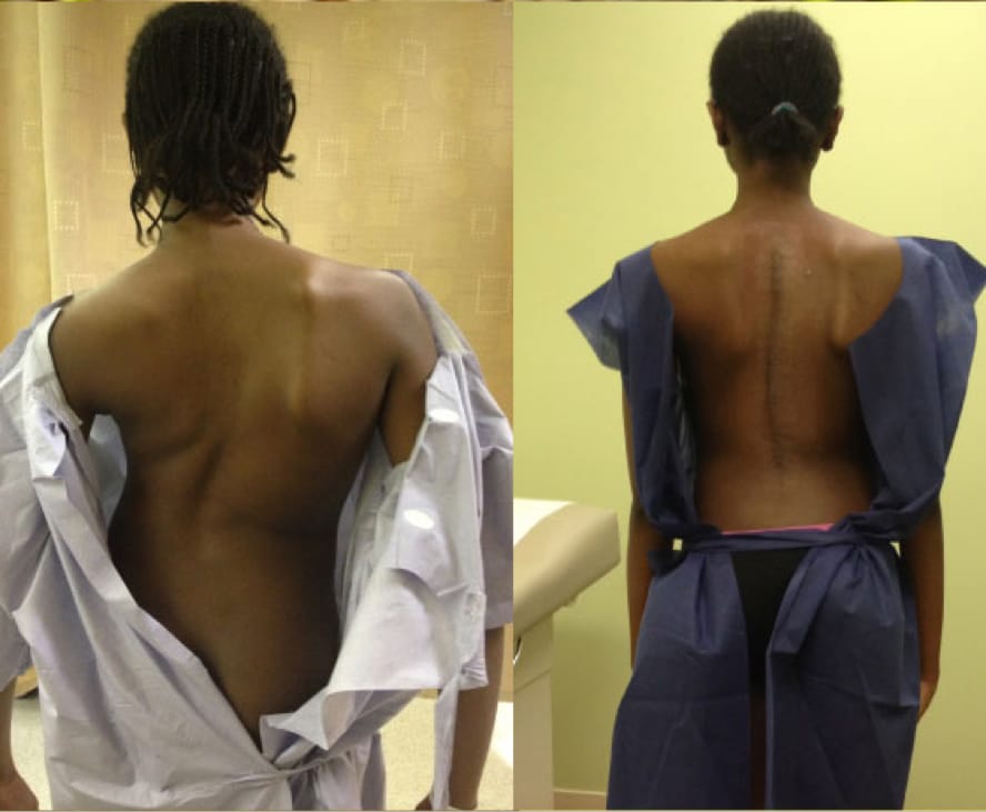 Adolescent Idiopathic Scoliosis case study