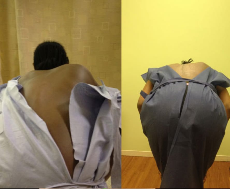 Adolescent Idiopathic Scoliosis case study
