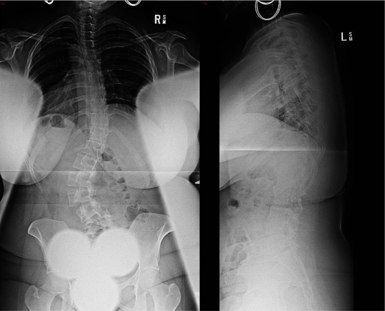Adult Scoliosis case study