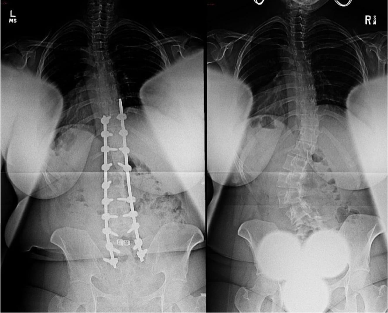 Adult Scoliosis case study