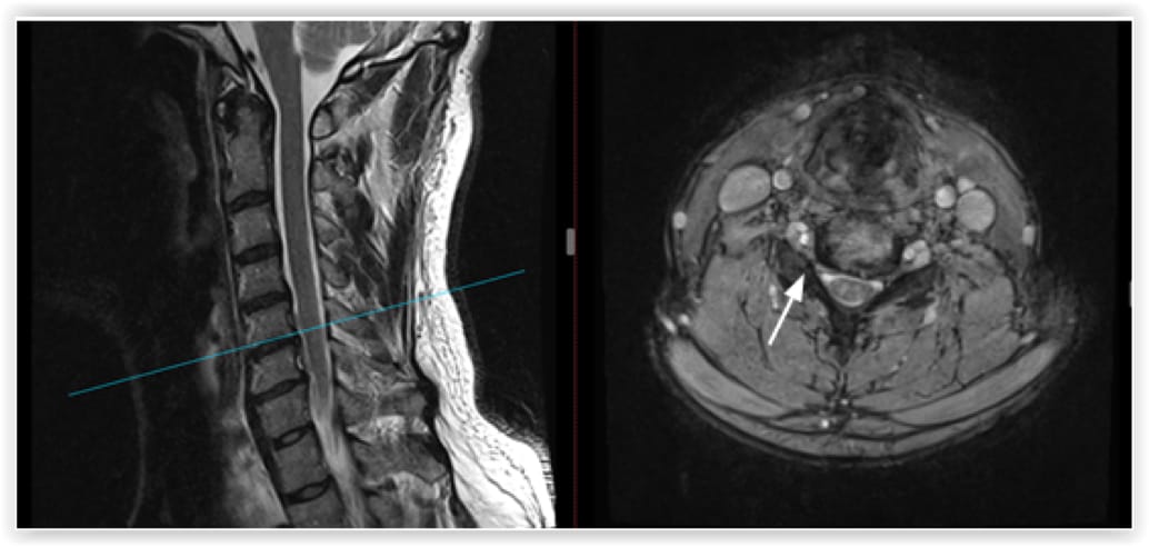 Cervical Foraminotomy case study