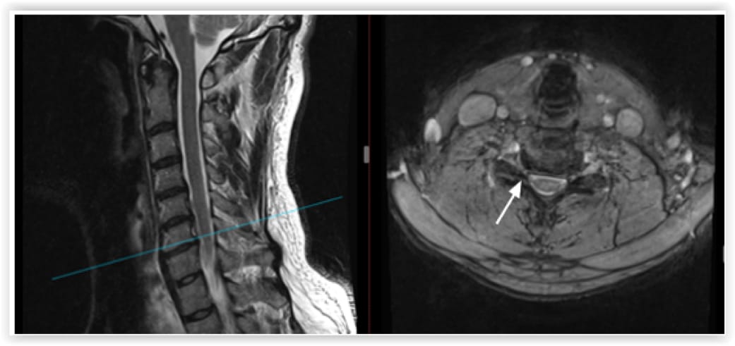 Cervical Foraminotomy case study