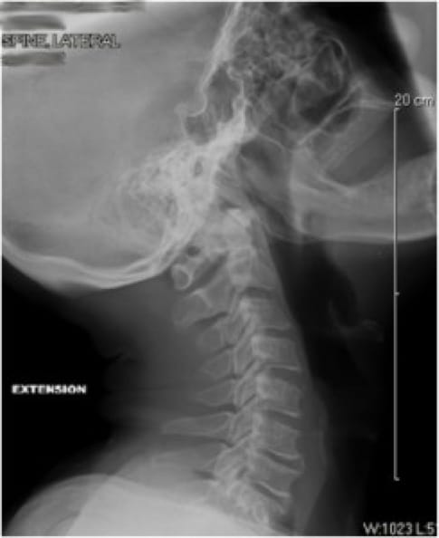 Cervical Myelopathy case study