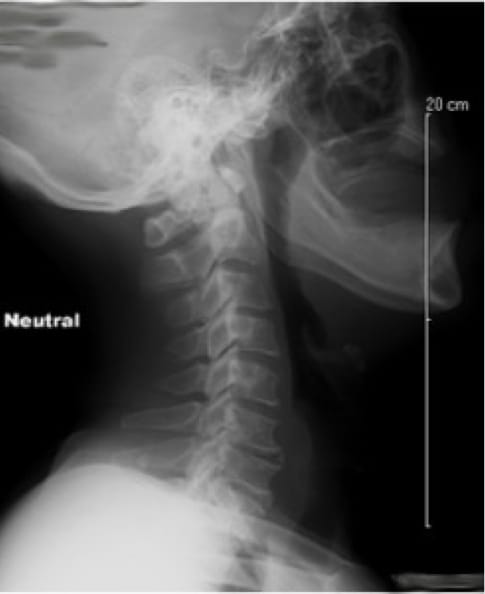Cervical Myelopathy case study