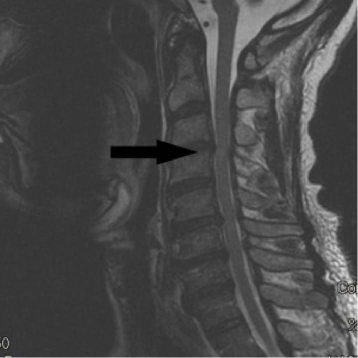 Cervical Myelopathy case study