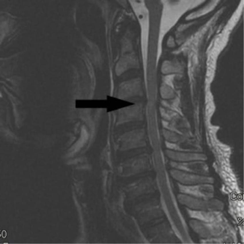 Cervical Myelopathy, OrthoManhattan