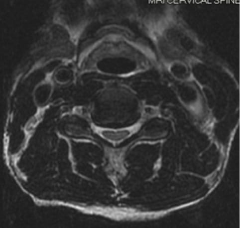 Cervical Myelopathy case study