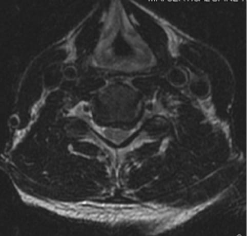 Cervical Myelopathy case study