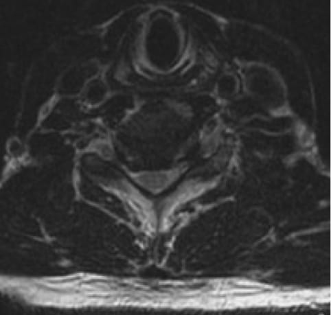 Cervical Myelopathy case study