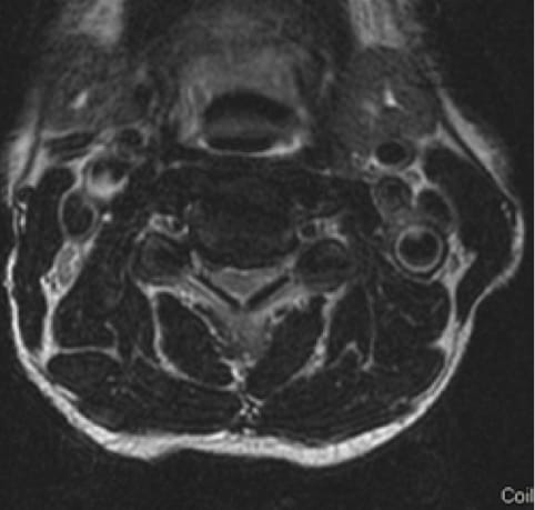 Cervical Myelopathy case study