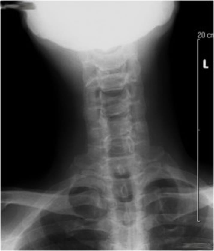 Cervical Myelopathy case study