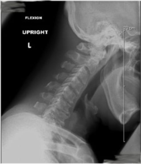 Cervical Myelopathy case study