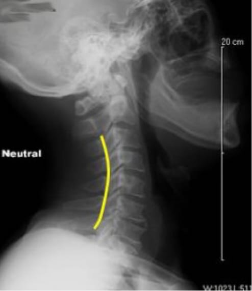 Cervical Myelopathy case study
