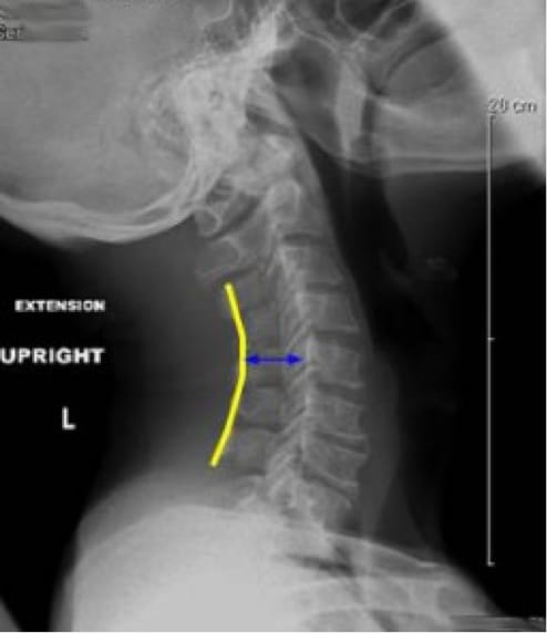 Cervical Myelopathy case study