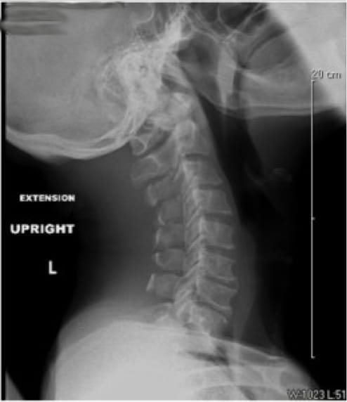 Cervical Myelopathy case study
