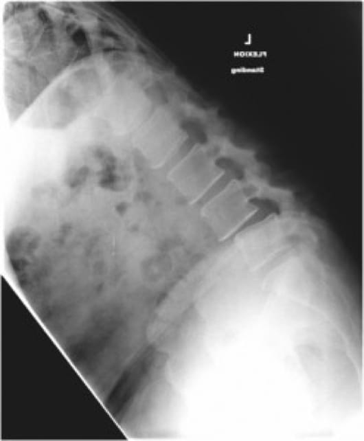 Grade 1 Spondylolisthesis case study