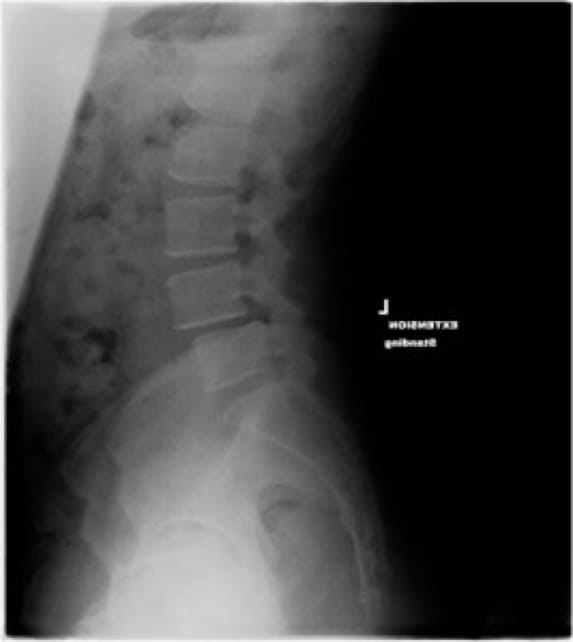 Grade 1 Spondylolisthesis case study