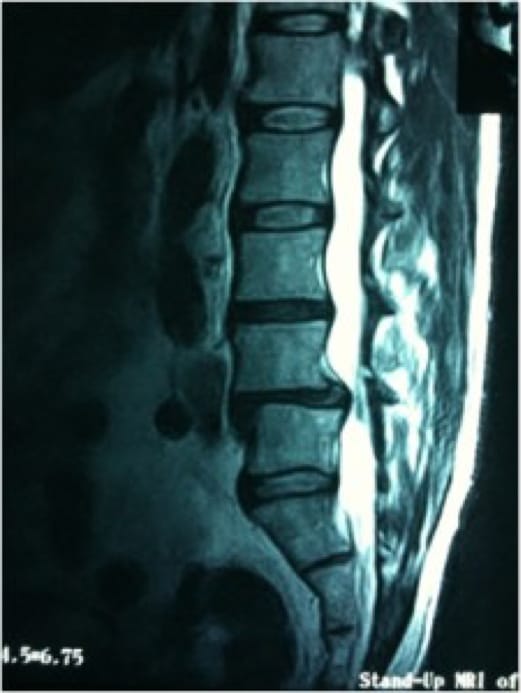 Grade 1 Spondylolisthesis case study
