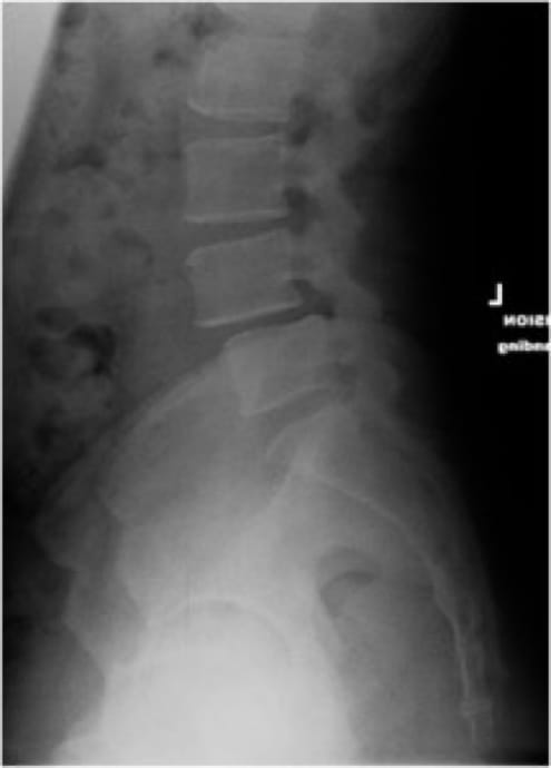 Grade 1 Spondylolisthesis case study