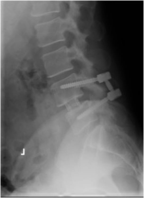 Grade 1 Spondylolisthesis case study