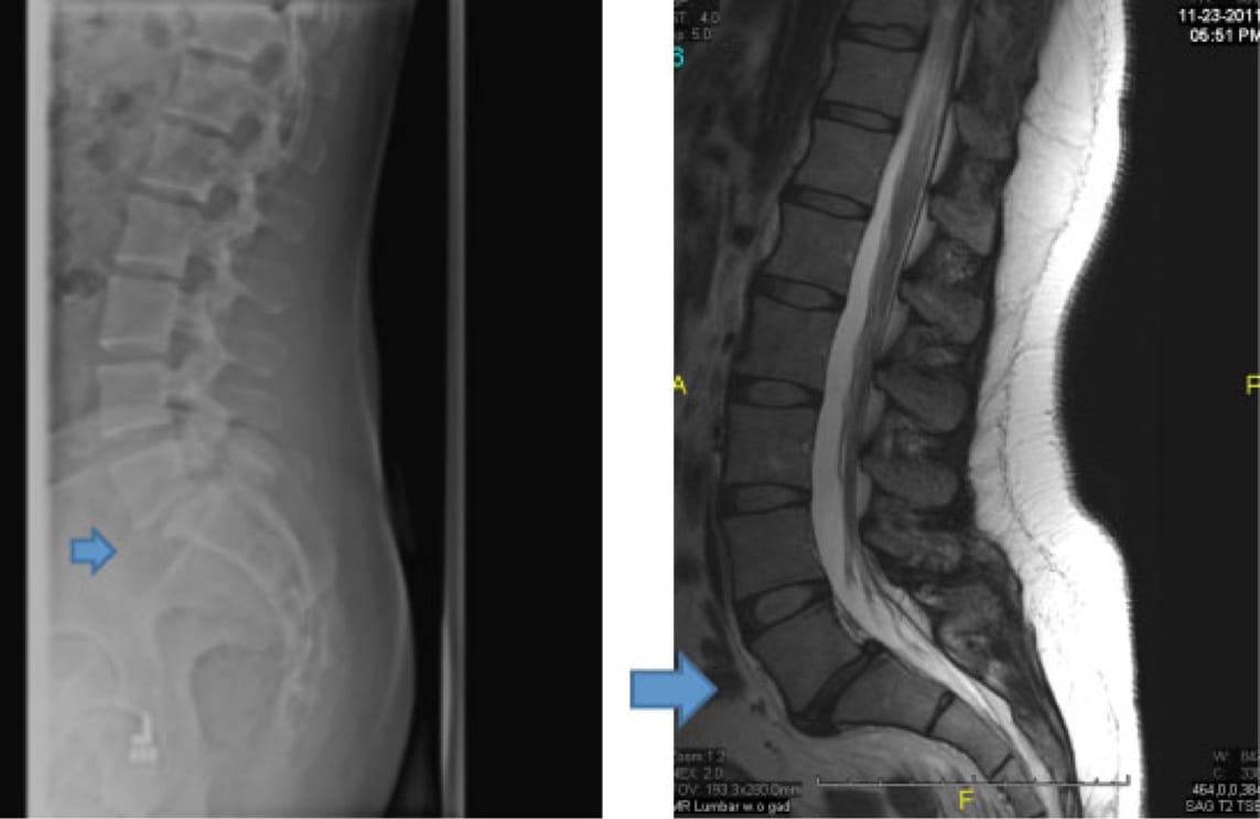 Isthmic Spondylolisthesis case study