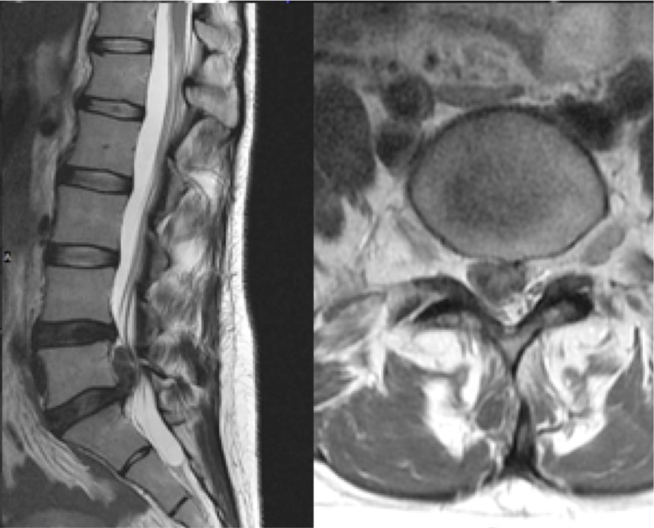 Lumbar Herniated Disc case study