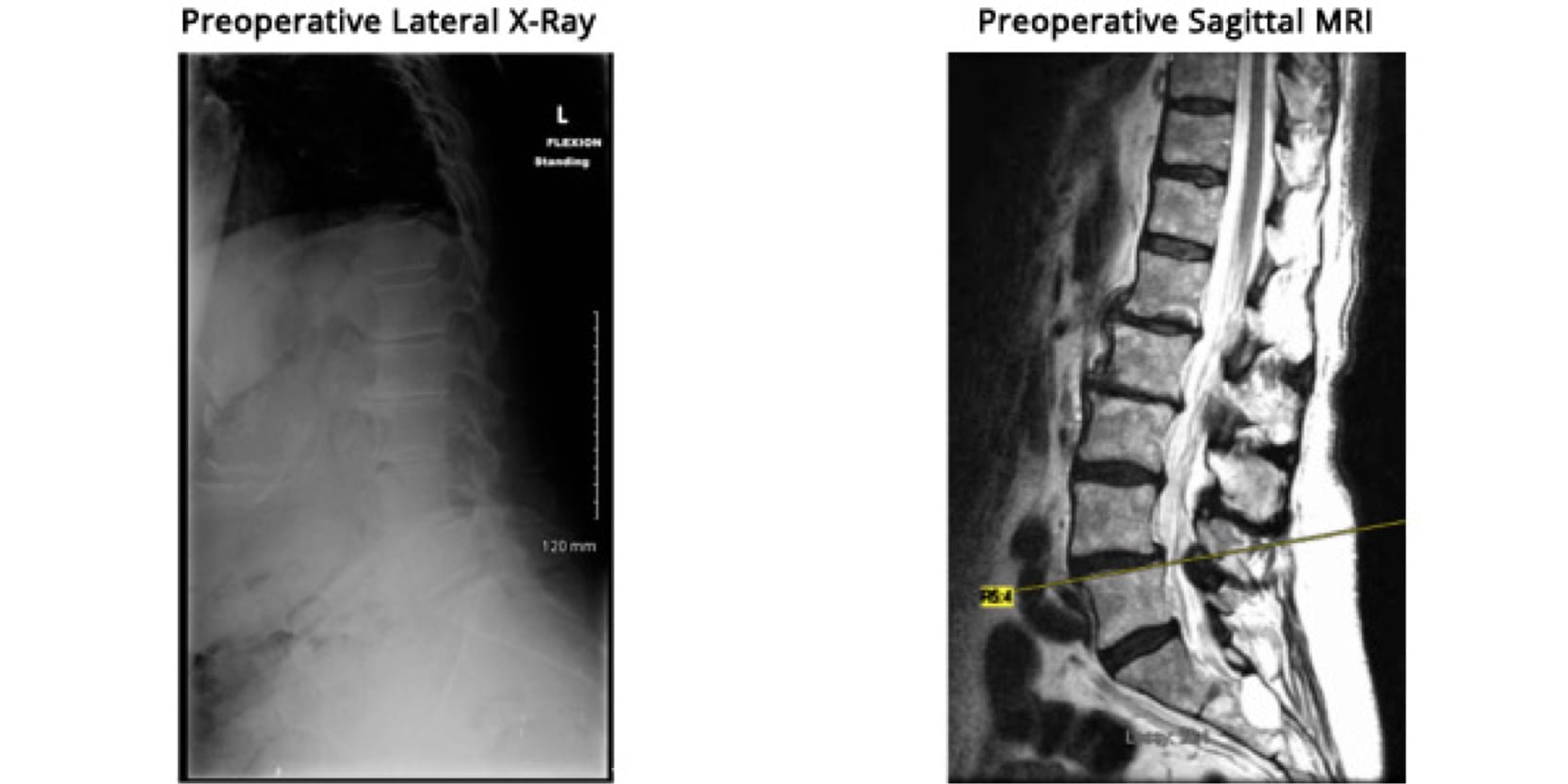 Minimally Invasive TLIF case study