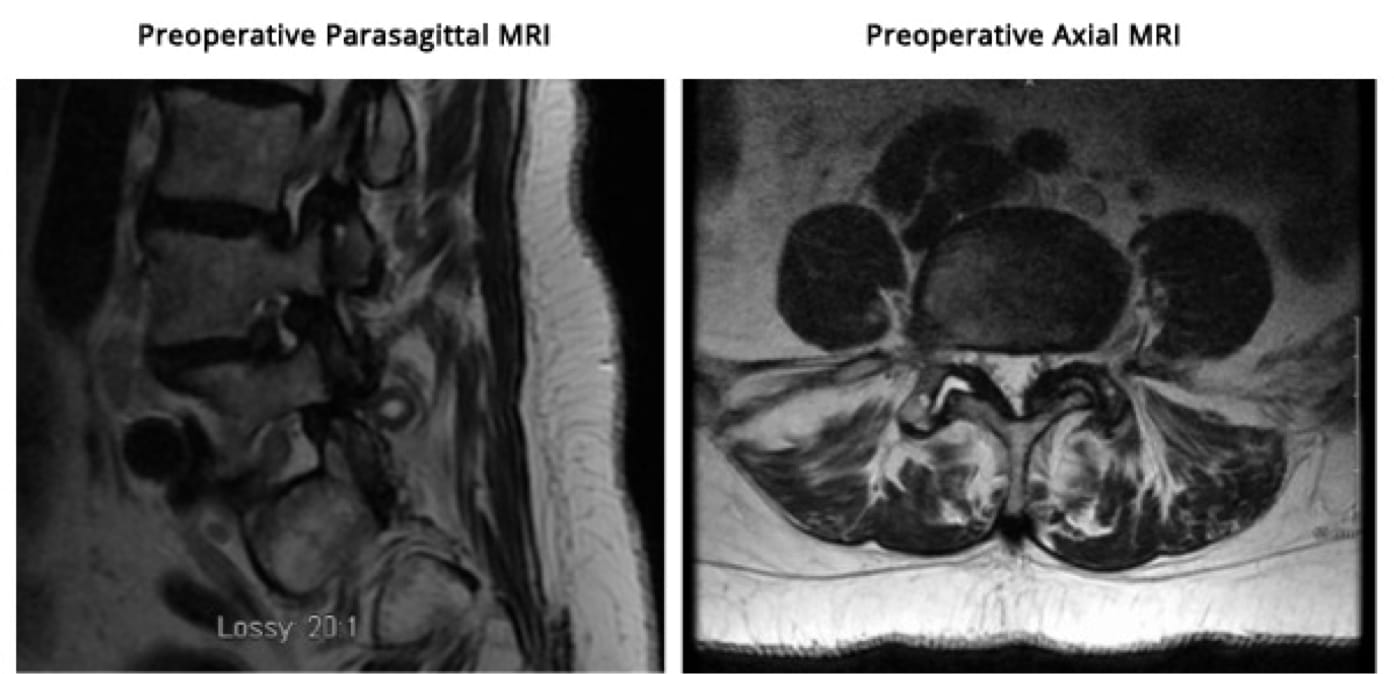 Minimally Invasive TLIF case study