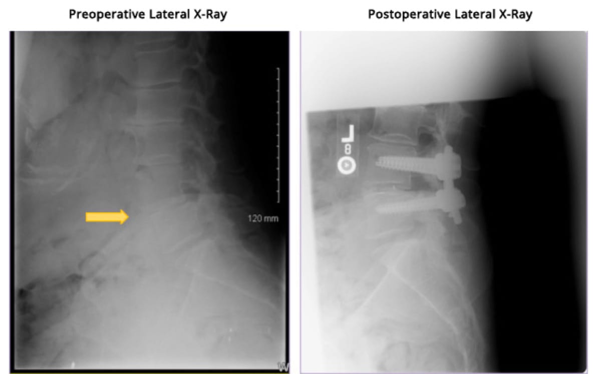 Minimally Invasive TLIF case study