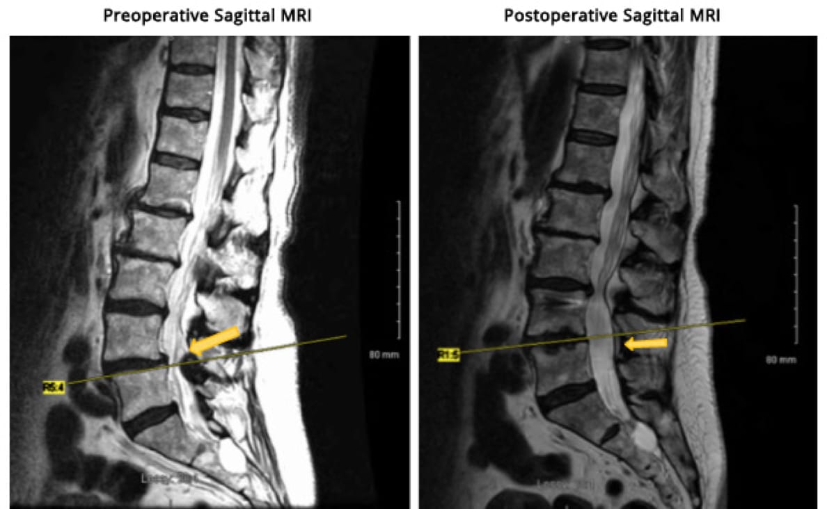 Minimally Invasive TLIF case study