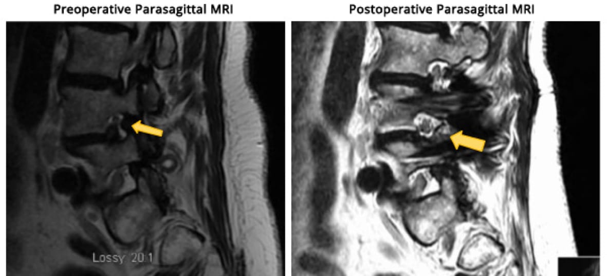 Minimally Invasive TLIF case study