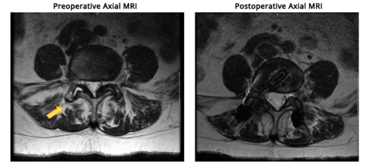 Minimally Invasive TLIF case study
