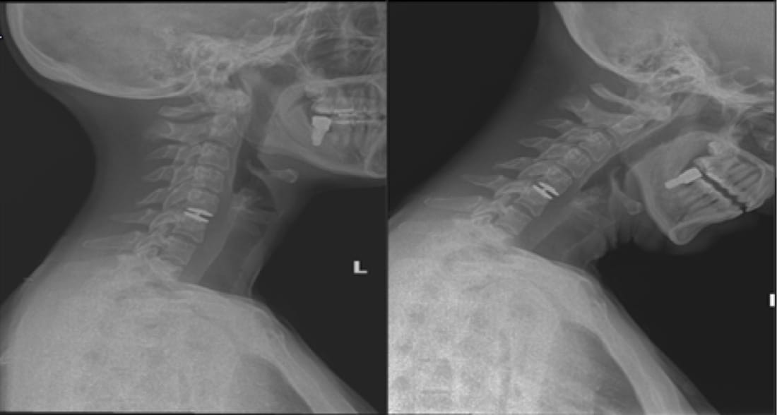 Mobi-C Disc Replacement case study