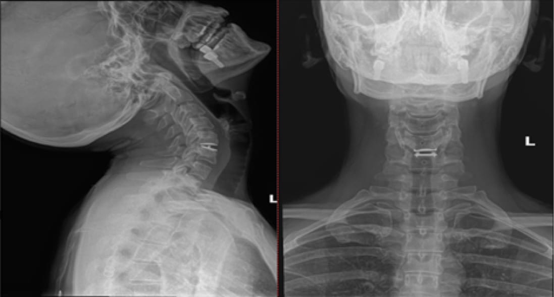 Mobi-C Disc Replacement case study