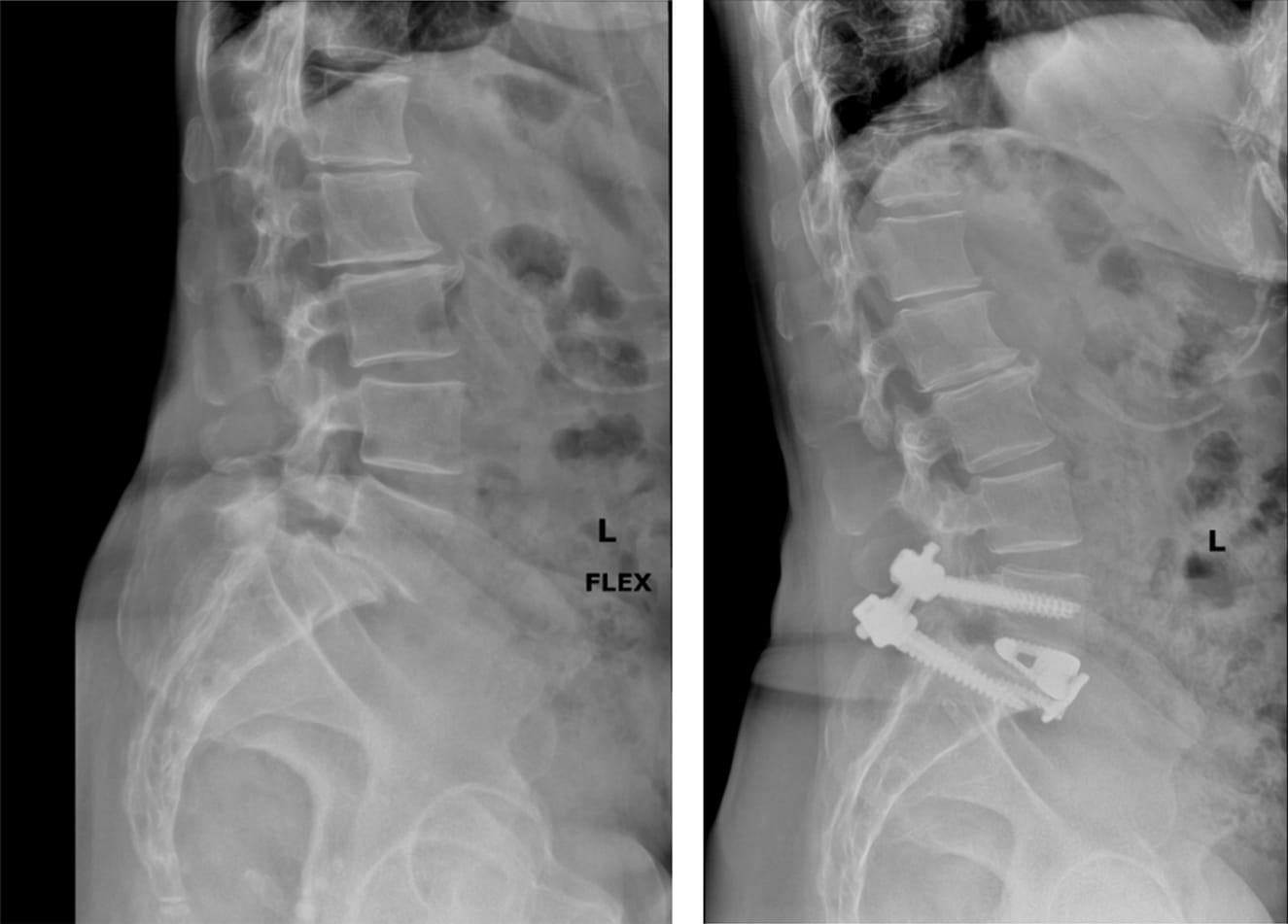 Spondylolisthesis Surgery