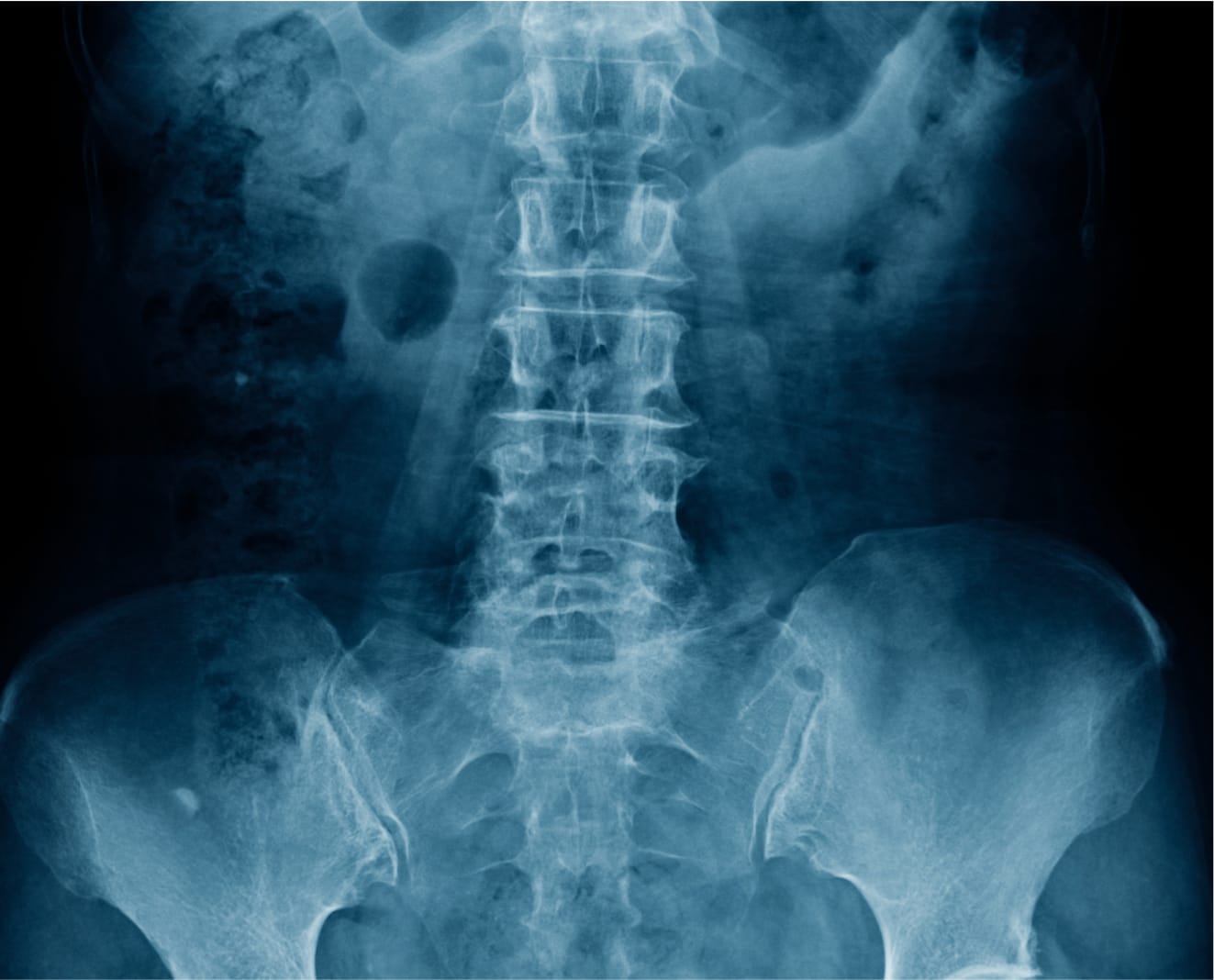 spondylosis