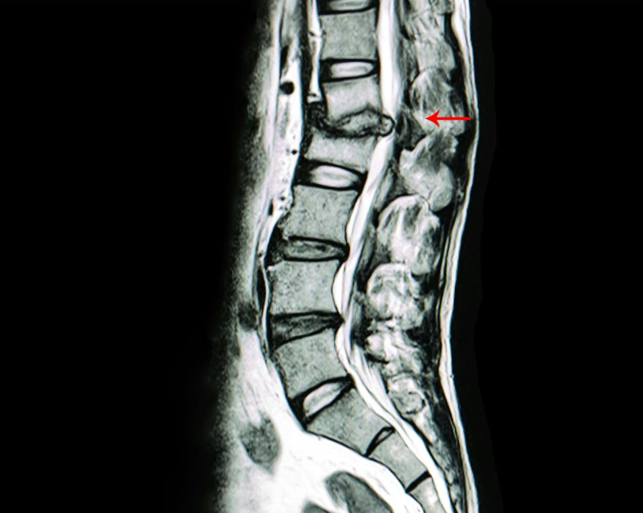 Spinal Stenosis Treatment NYC