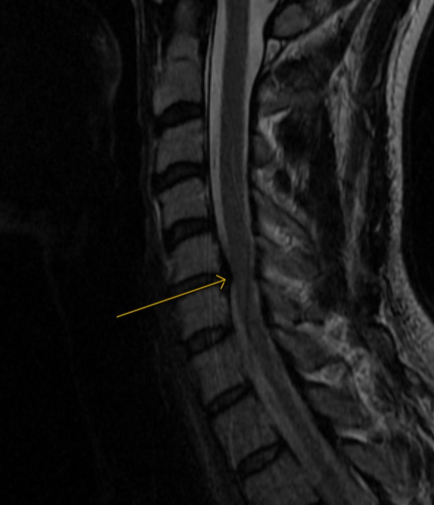 Disc Herniation