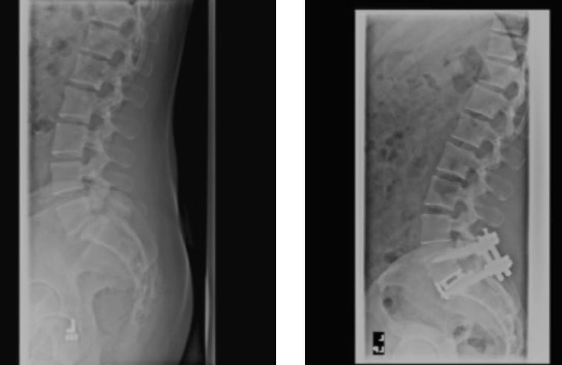 Isthmic Spondylolisthesis case study