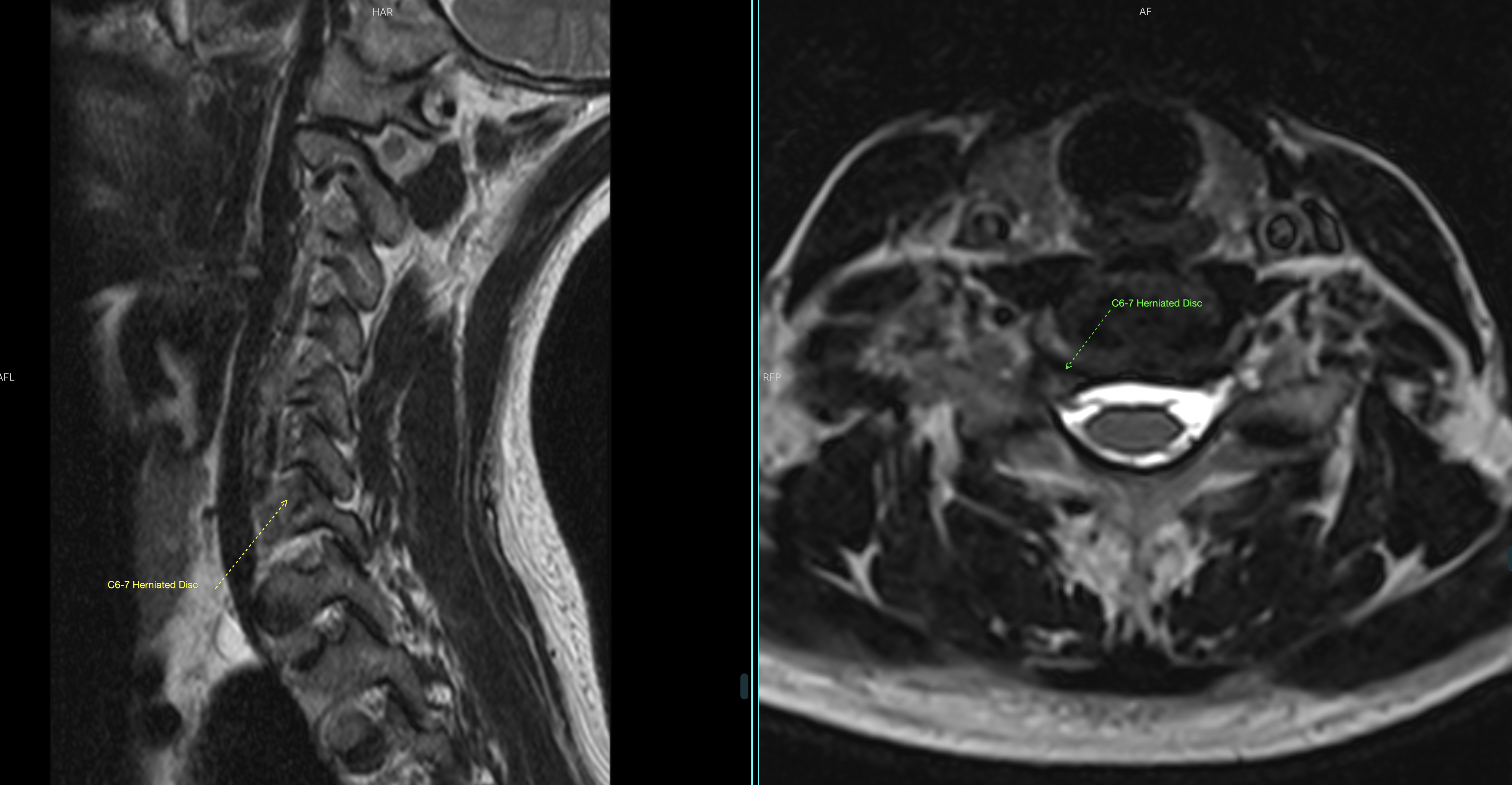 Cervical Herniated Disc case study