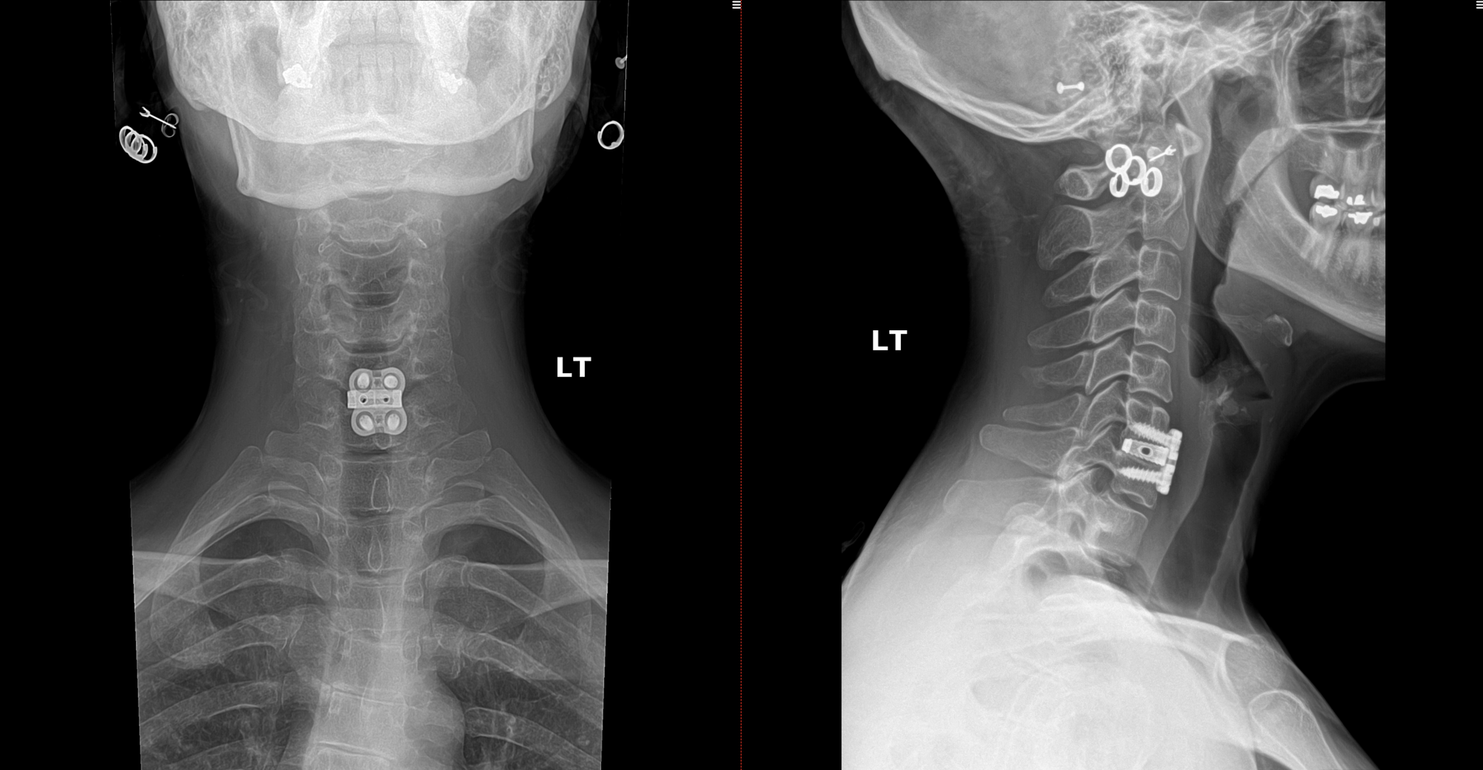 Cervical Herniated Disc case study
