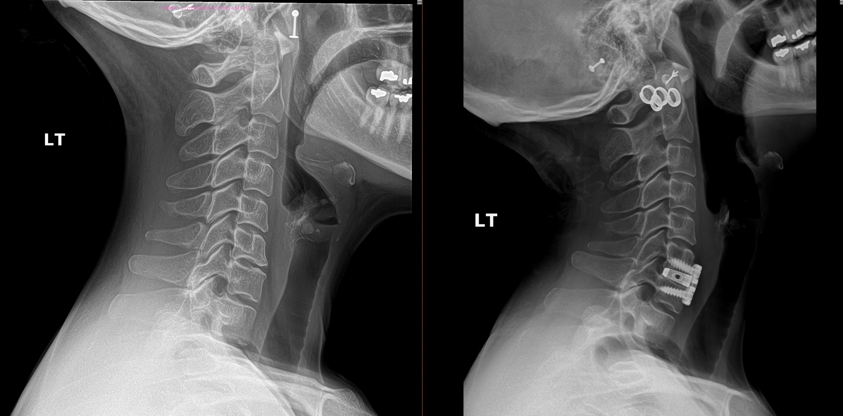 Cervical Herniated Disc case study