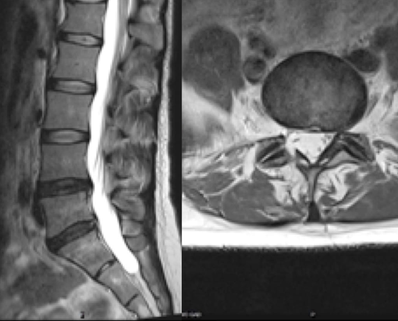 Lumbar Herniated Disc case study