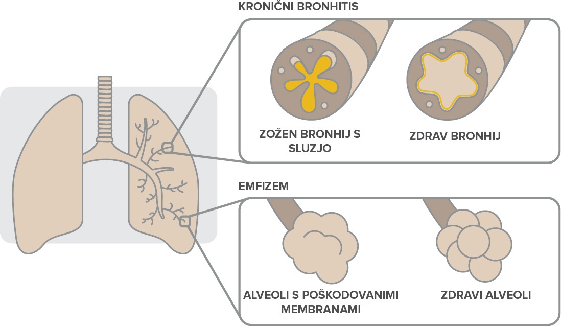 Kaj je KOPB in zakaj jo je treba odkriti zgodaj?