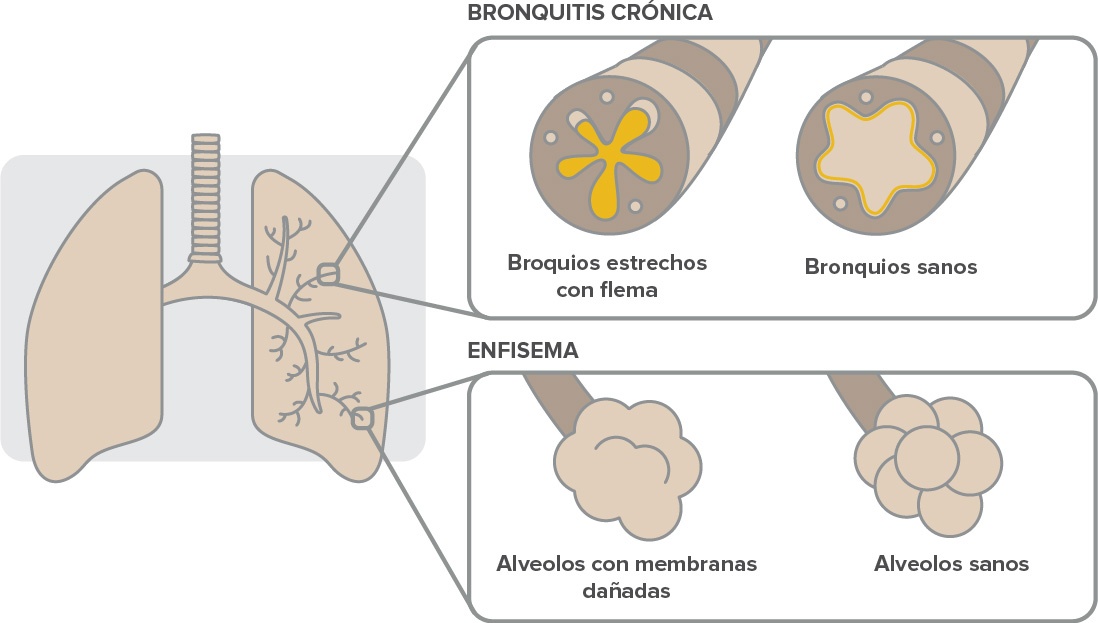 ¿Qué es la EPOC y por qué debe detectarse temprano?