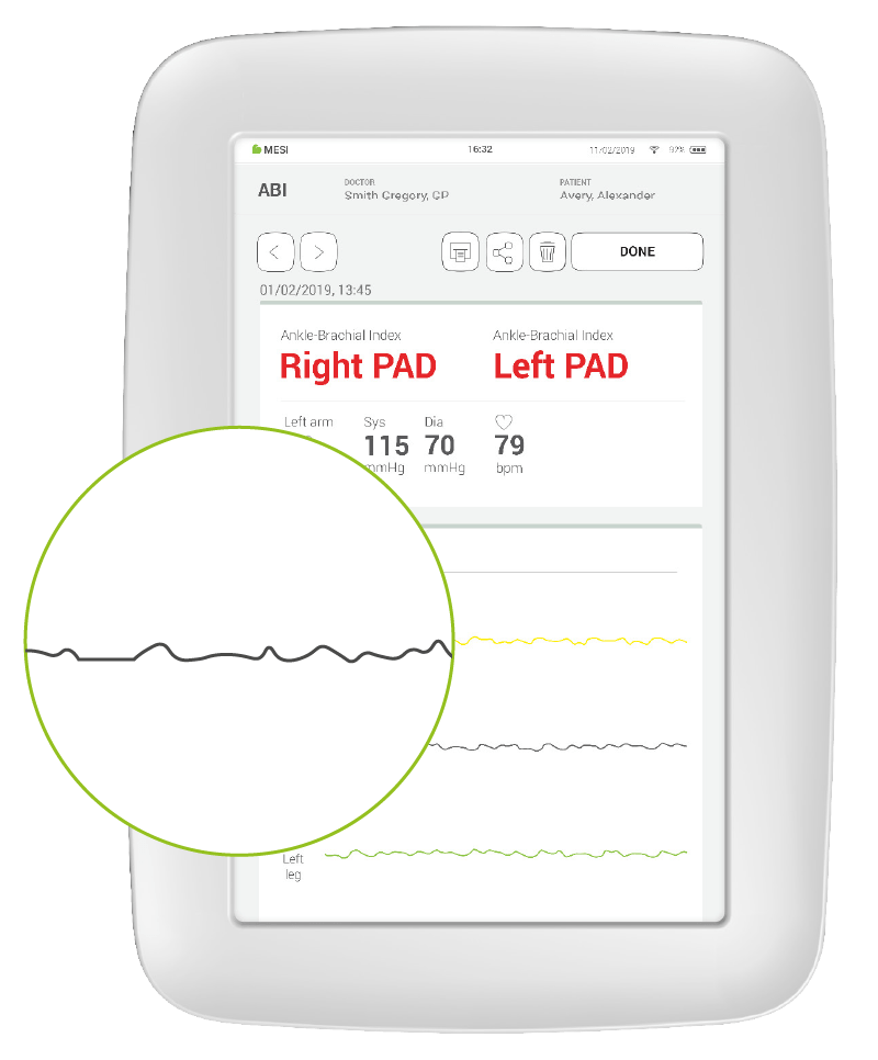 ABI pulse waveform recording and ABI reference scale - Abnormal result