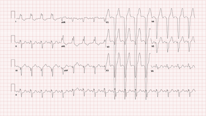 Left bundle branch block