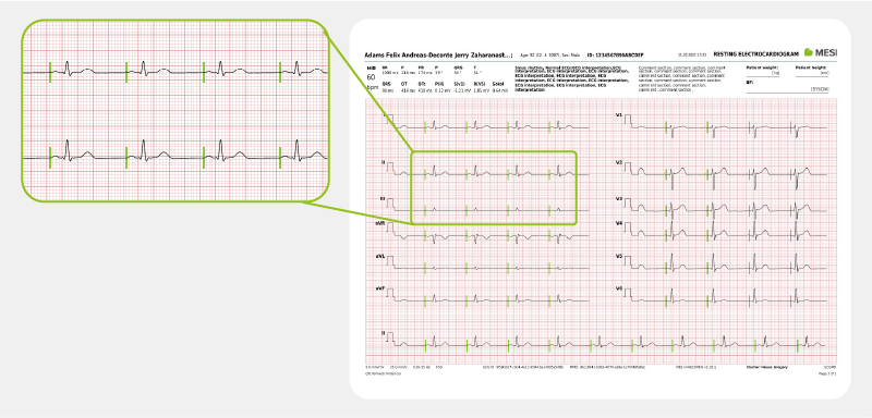 Pacemaker detection