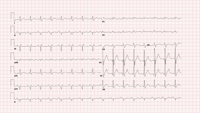 Right bundle branch block